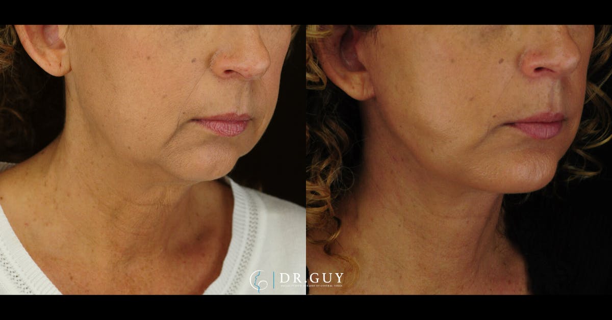 Chin Before & After Gallery - Patient 666945 - Image 2