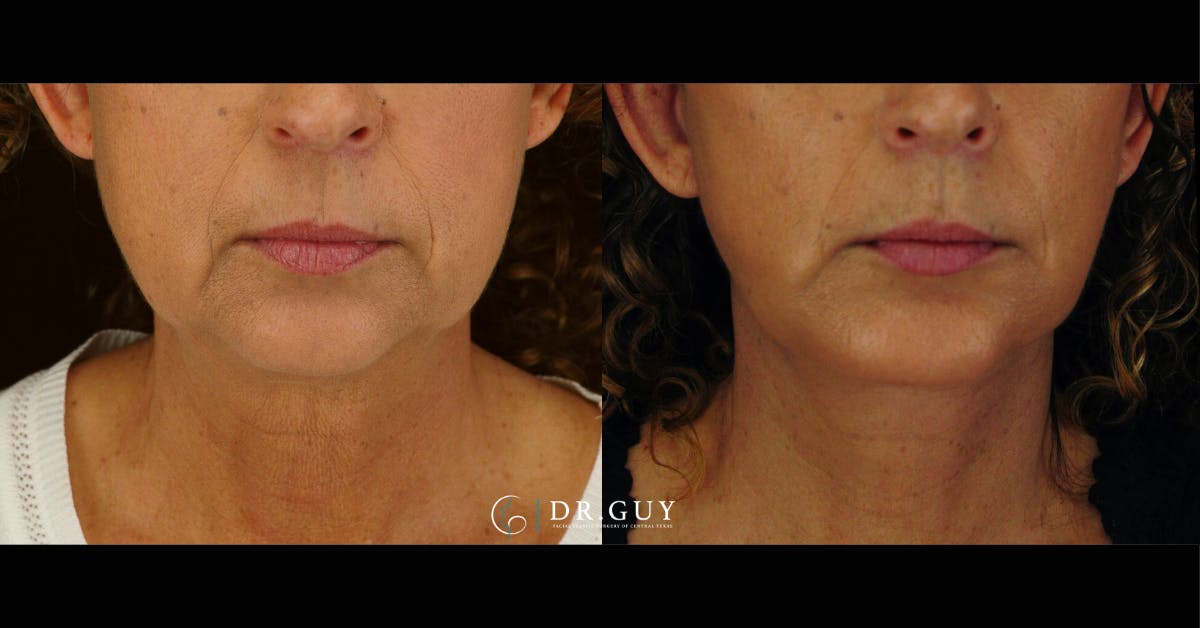 Chin Before & After Gallery - Patient 666945 - Image 3