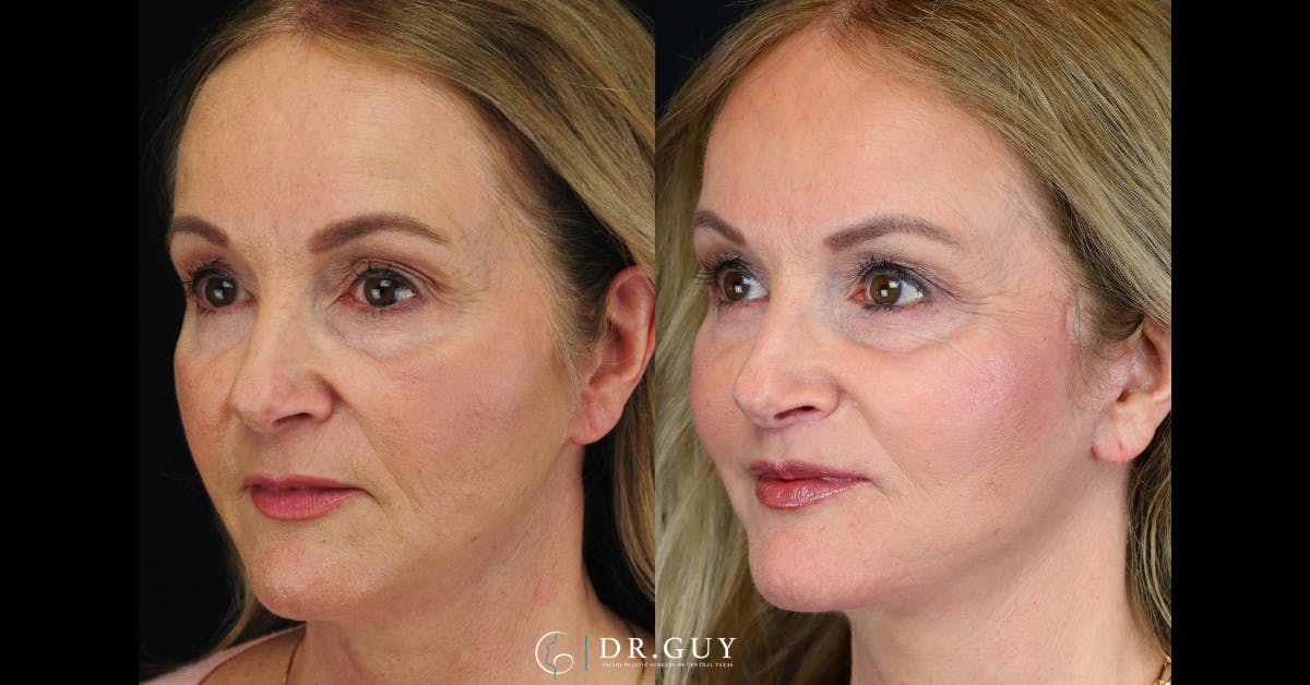 Lip Lift Before & After Gallery - Patient 376573 - Image 2