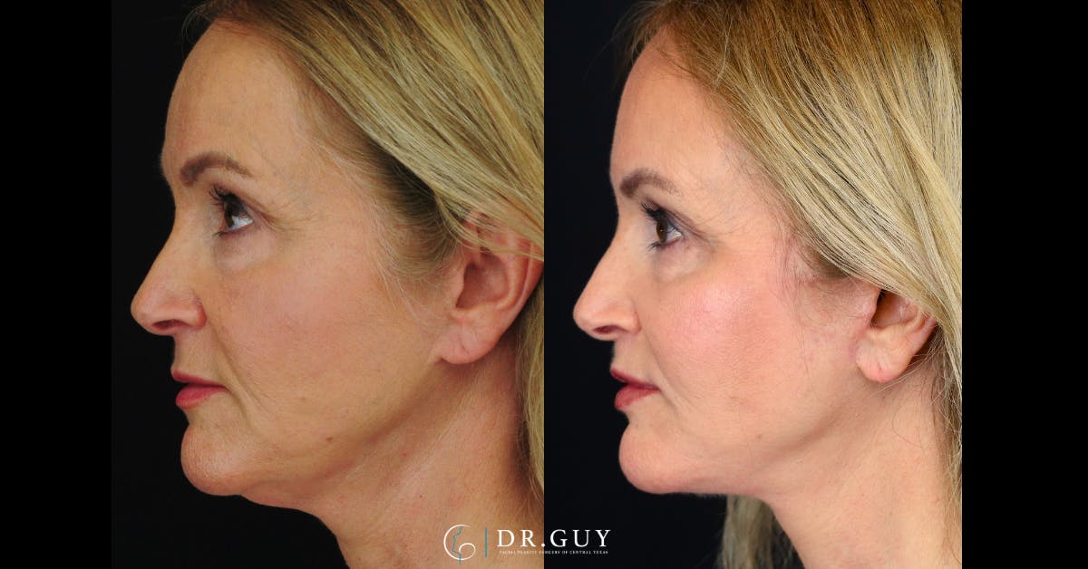 Lip Lift Before & After Gallery - Patient 376573 - Image 4