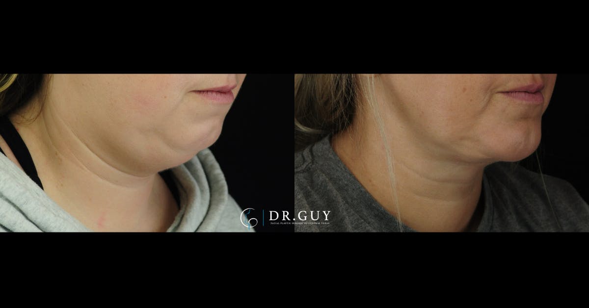 Chin Before & After Gallery - Patient 127249 - Image 3
