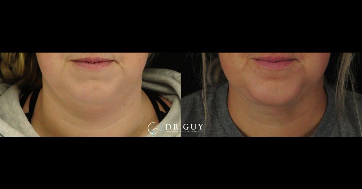 Chin Before & After Gallery - Patient 127249 - Image 5