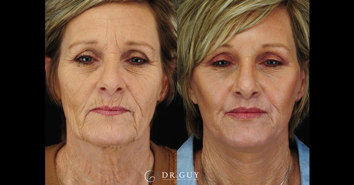 Lip Lift Before & After Gallery - Patient 210418 - Image 1