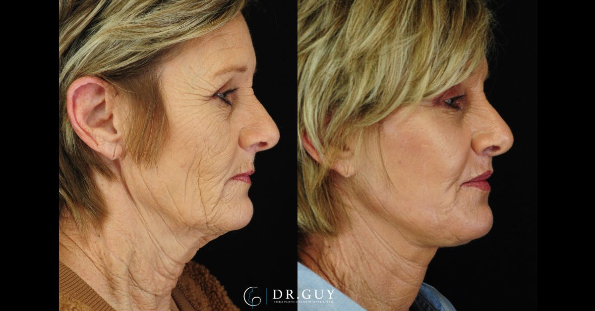 Lip Lift Before & After Gallery - Patient 210418 - Image 2