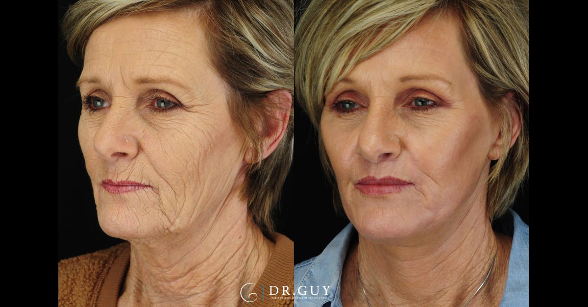 Lip Lift Before & After Gallery - Patient 210418 - Image 5