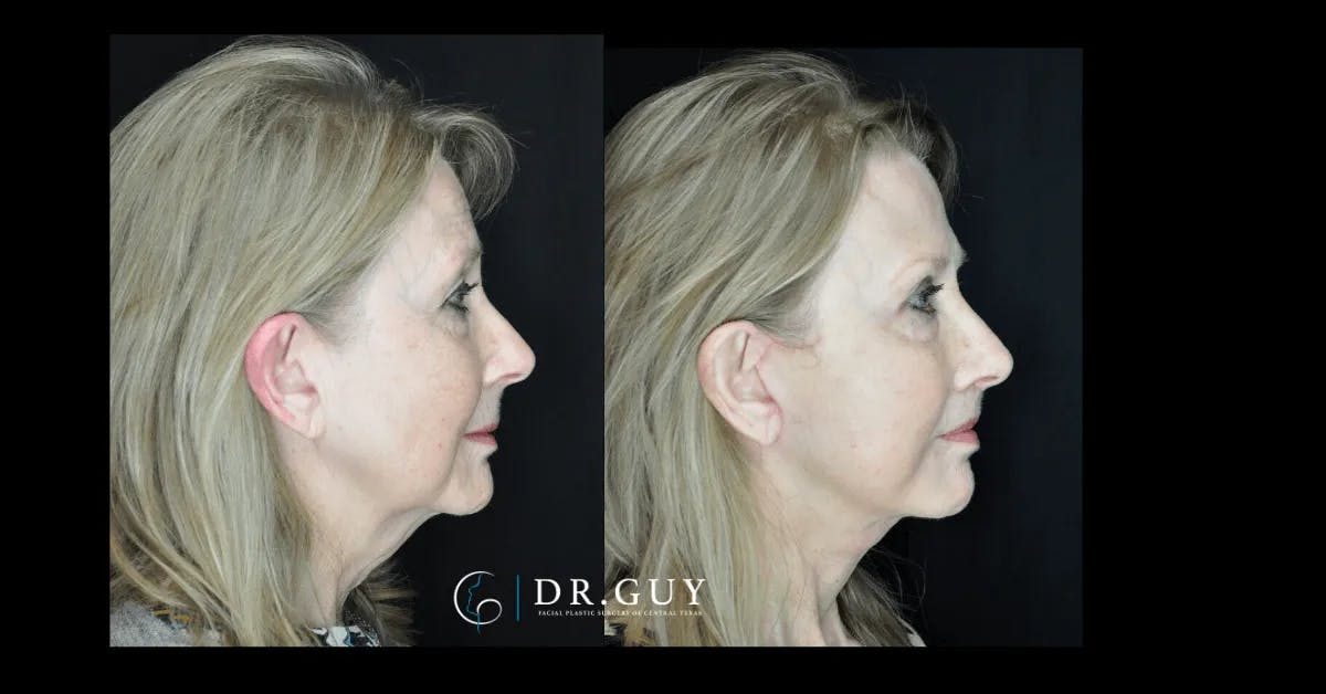 Lip Lift Before & After Gallery - Patient 122229 - Image 2