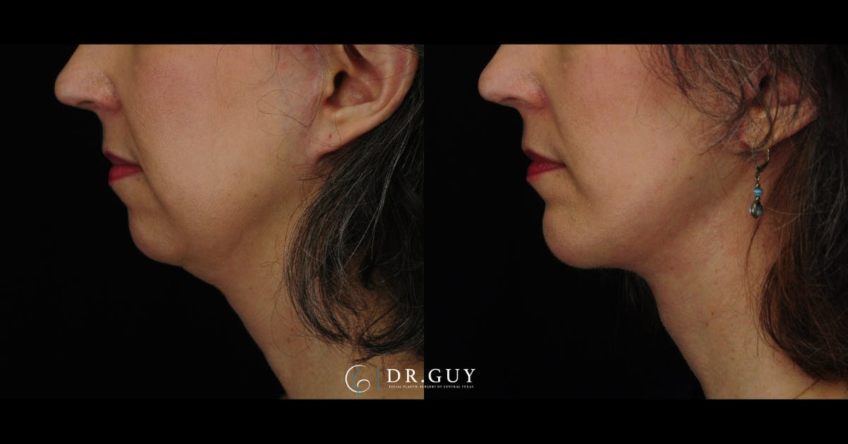 Chin Before & After Gallery - Patient 385106 - Image 1