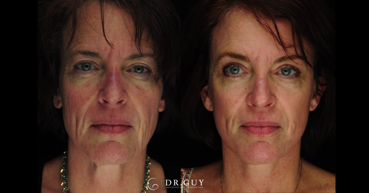 Mini Facelift Before & After Gallery - Patient 389522 - Image 3