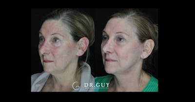 Lip Lift Before & After Gallery - Patient 291752 - Image 1