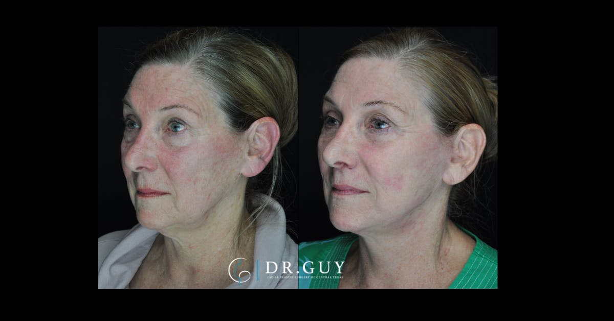 Lip Lift Before & After Gallery - Patient 291752 - Image 1
