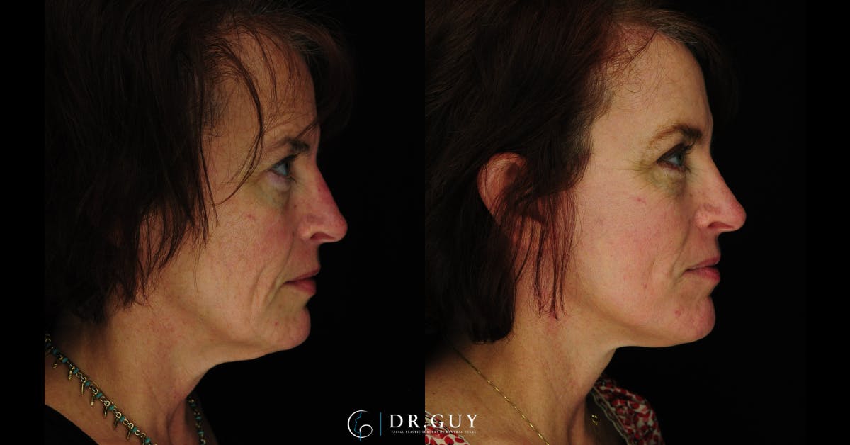 Mini Facelift Before & After Gallery - Patient 389522 - Image 5