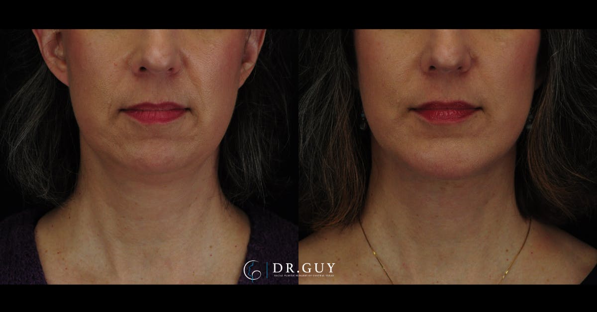 Chin Before & After Gallery - Patient 385106 - Image 5