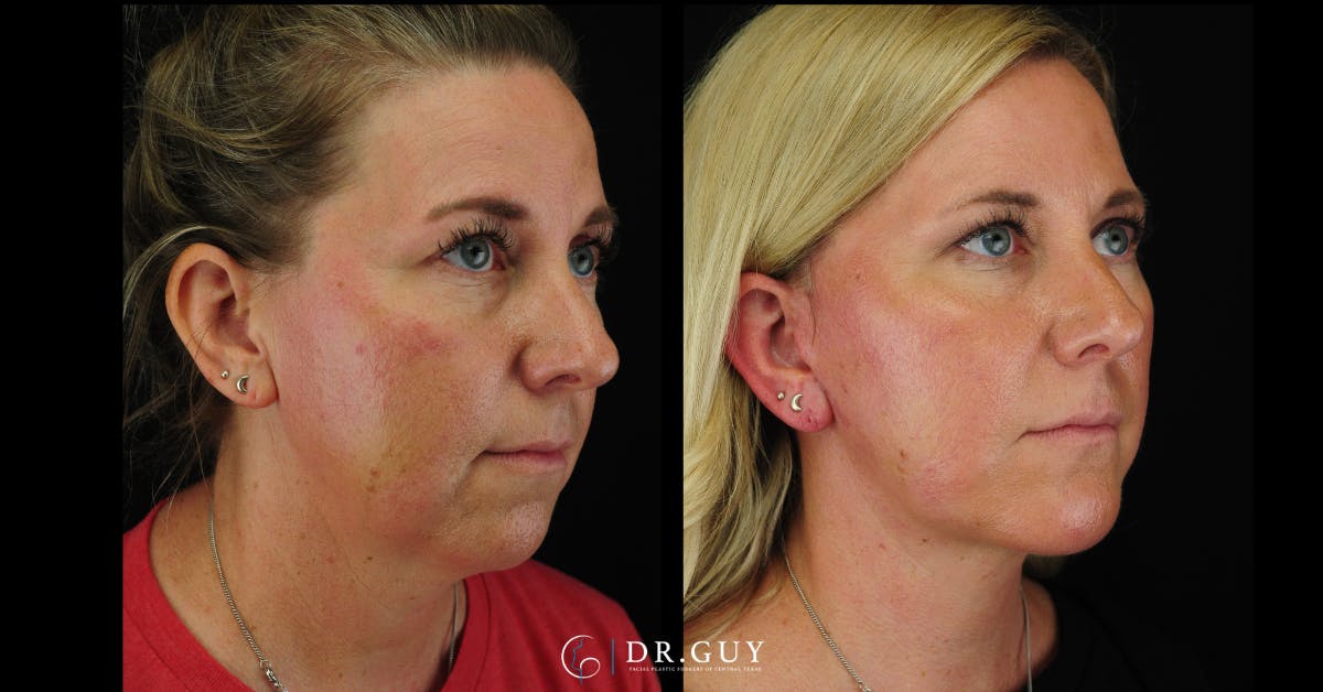 Chin Before & After Gallery - Patient 326465 - Image 5