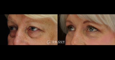 Lower Blepharoplasty Before & After Gallery - Patient 384679 - Image 1