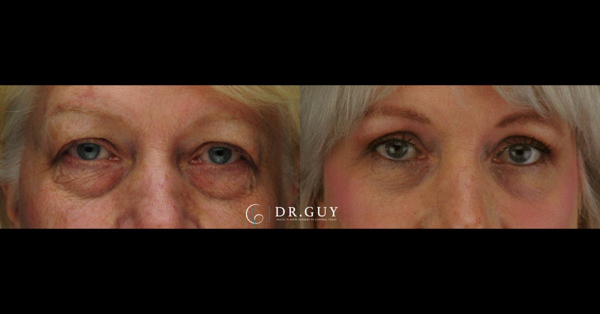 Lower Blepharoplasty Before & After Gallery - Patient 384679 - Image 3