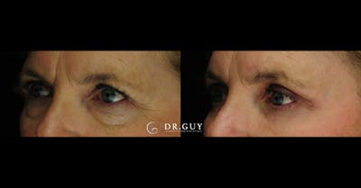 Browlift Before & After Gallery - Patient 781891 - Image 1