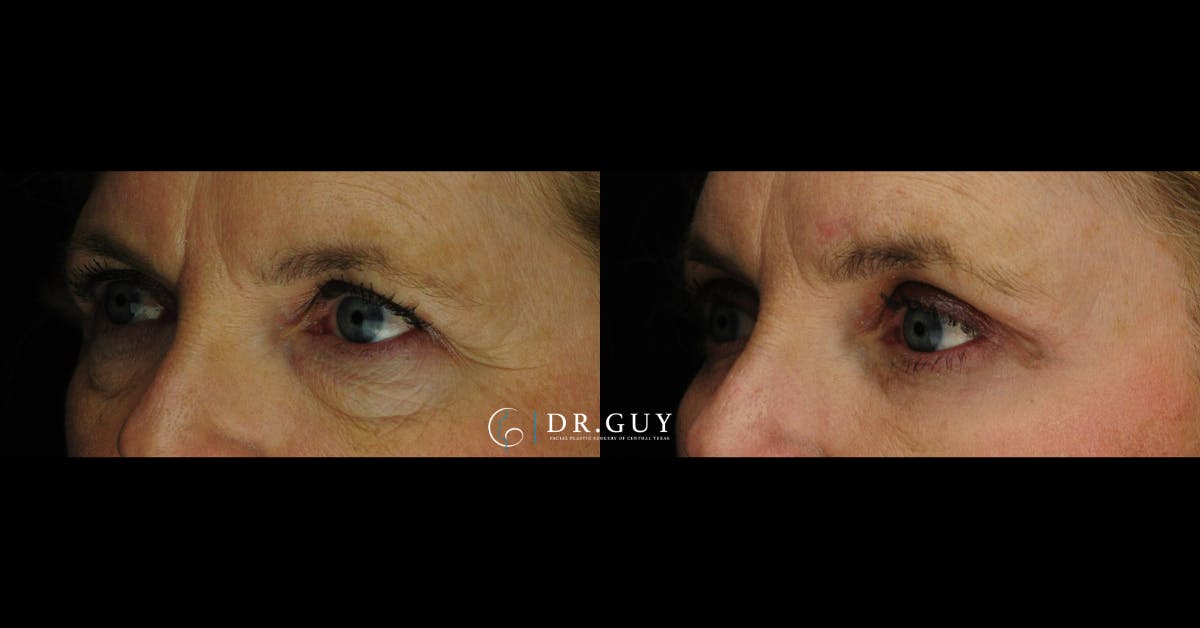 Browlift Before & After Gallery - Patient 781891 - Image 1