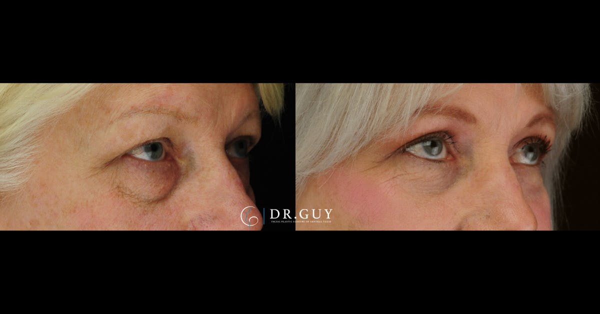 Lower Blepharoplasty Before & After Gallery - Patient 384679 - Image 4