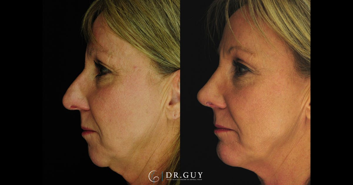 Chin Before & After Gallery - Patient 314905 - Image 3
