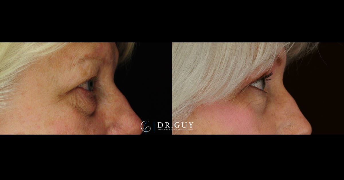 Lower Blepharoplasty Before & After Gallery - Patient 384679 - Image 5