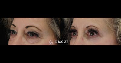 Lower Blepharoplasty Before & After Gallery - Patient 234744 - Image 1