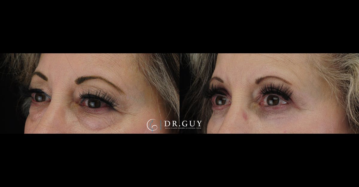 Lower Blepharoplasty Before & After Gallery - Patient 234744 - Image 1