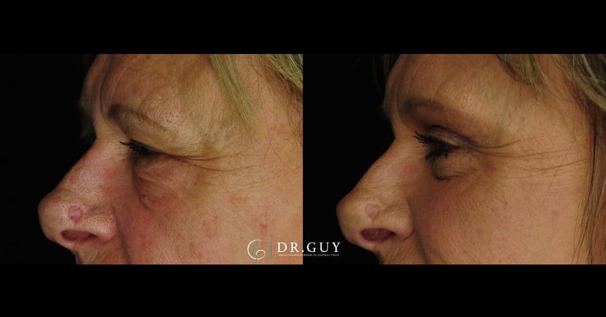 Upper Blepharoplasty Before & After Gallery - Patient 137071 - Image 3