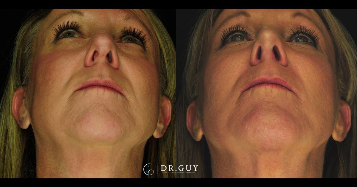 Chin Before & After Gallery - Patient 314905 - Image 6