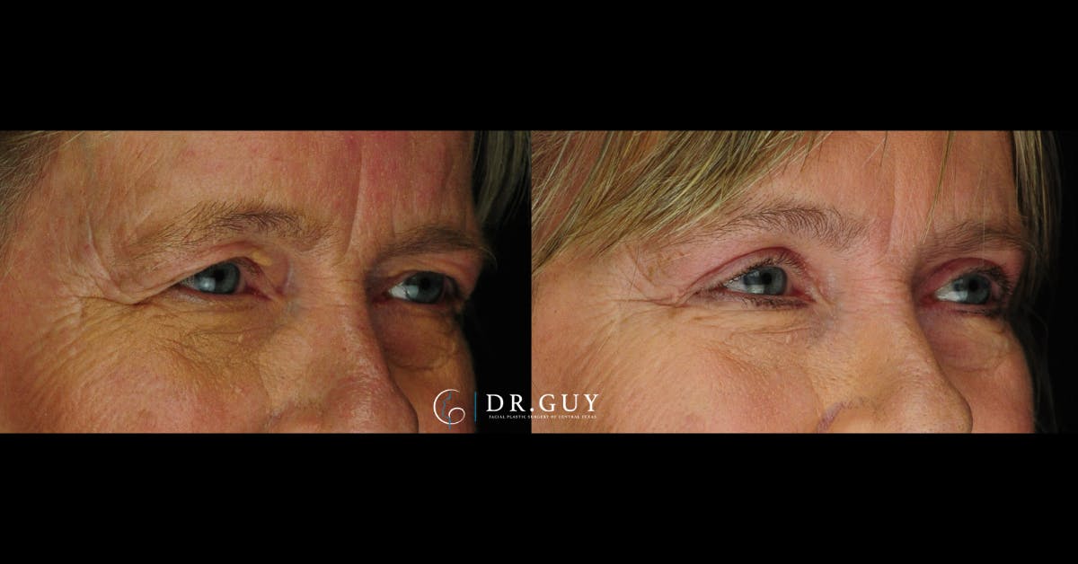 Browlift Before & After Gallery - Patient 320362 - Image 3