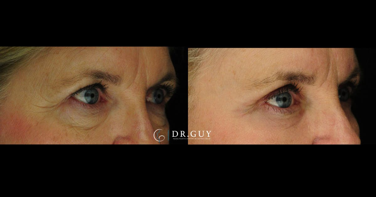 Lower Blepharoplasty Before & After Gallery - Patient 414994 - Image 2