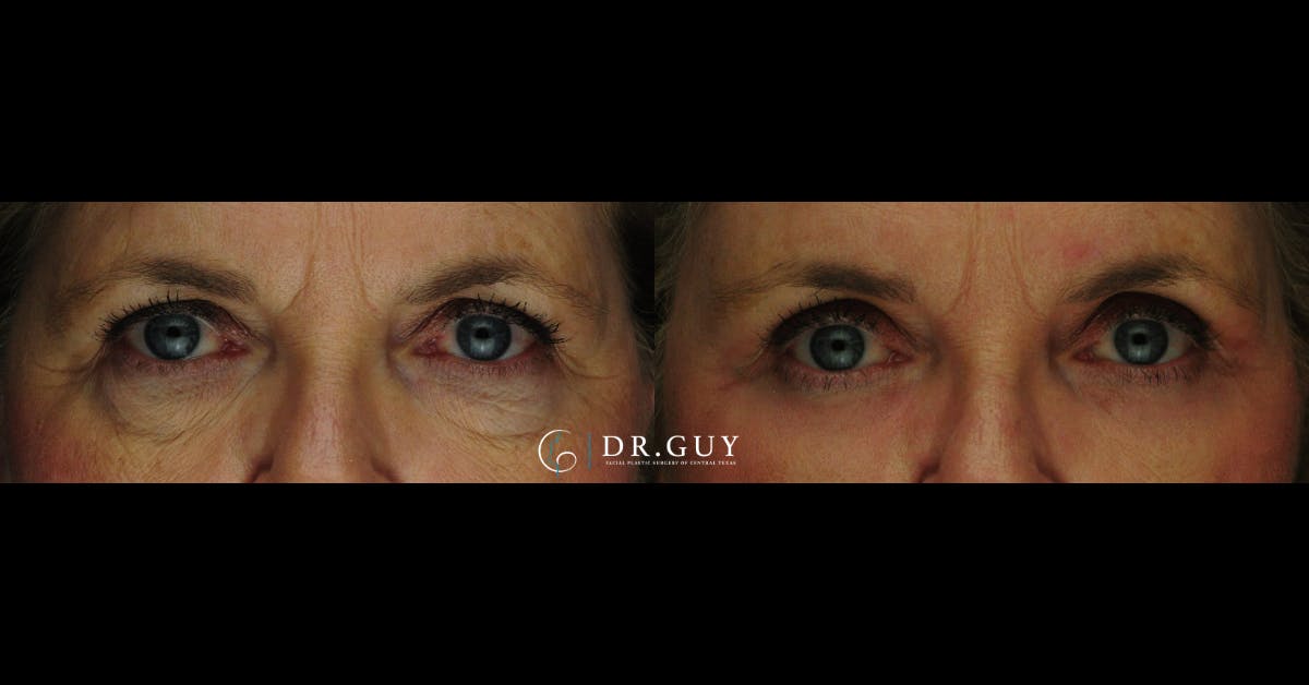 Lower Blepharoplasty Before & After Gallery - Patient 414994 - Image 3