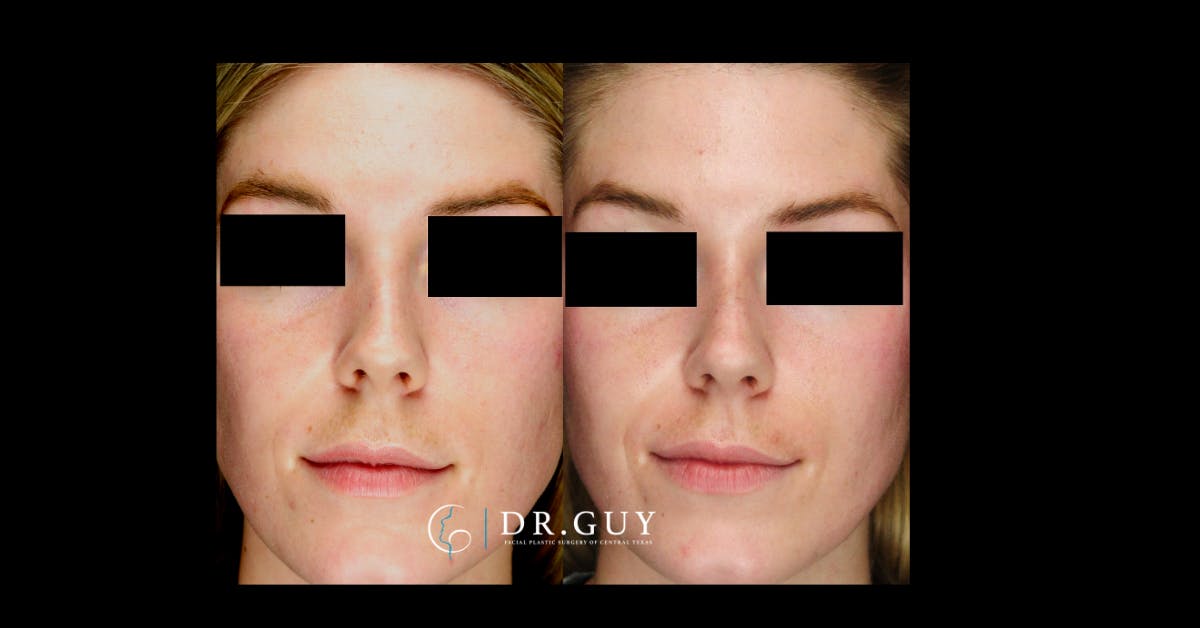 Liquid Rhinoplasty Before & After Gallery - Patient 272738 - Image 2