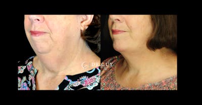 Chin Before & After Gallery - Patient 780384 - Image 1