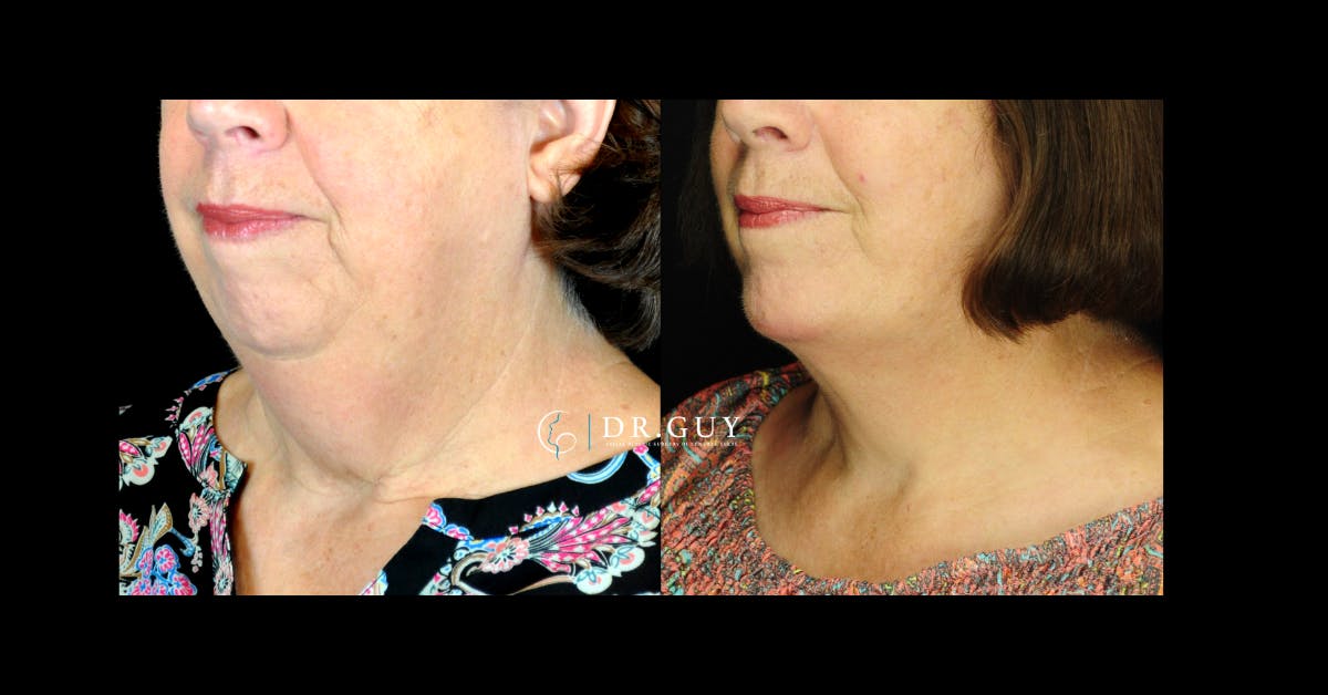 Chin Before & After Gallery - Patient 780384 - Image 1