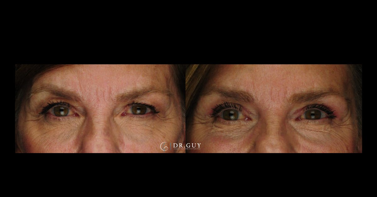 Browlift Before & After Gallery - Patient 559535 - Image 5