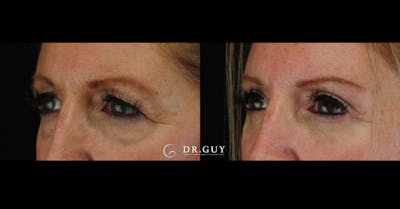 Lower Blepharoplasty Before & After Gallery - Patient 327769 - Image 1