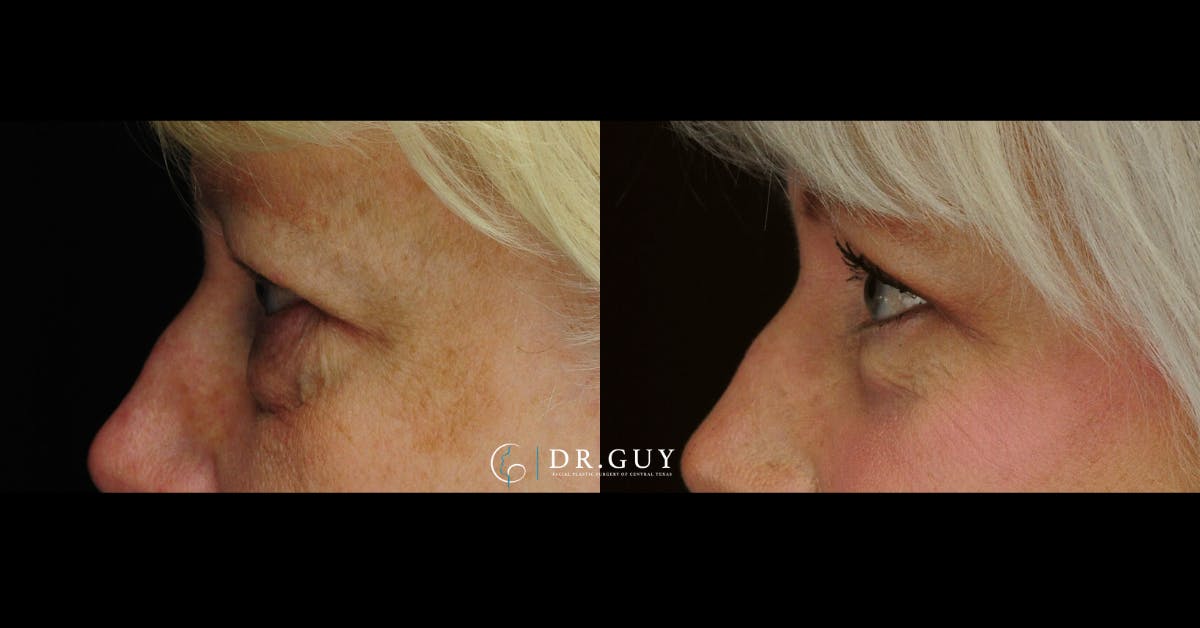 Upper Blepharoplasty Before & After Gallery - Patient 114951 - Image 2