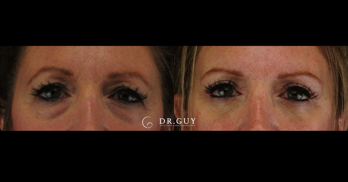 Browlift Before & After Gallery - Patient 412780 - Image 3