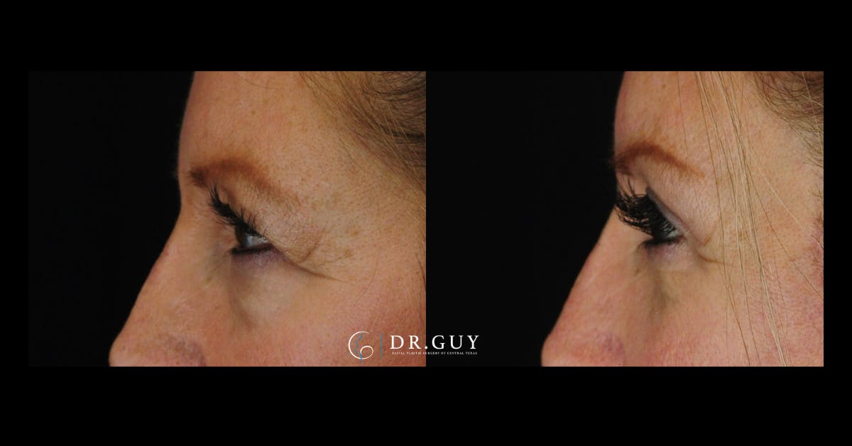 Browlift Before & After Gallery - Patient 412780 - Image 4