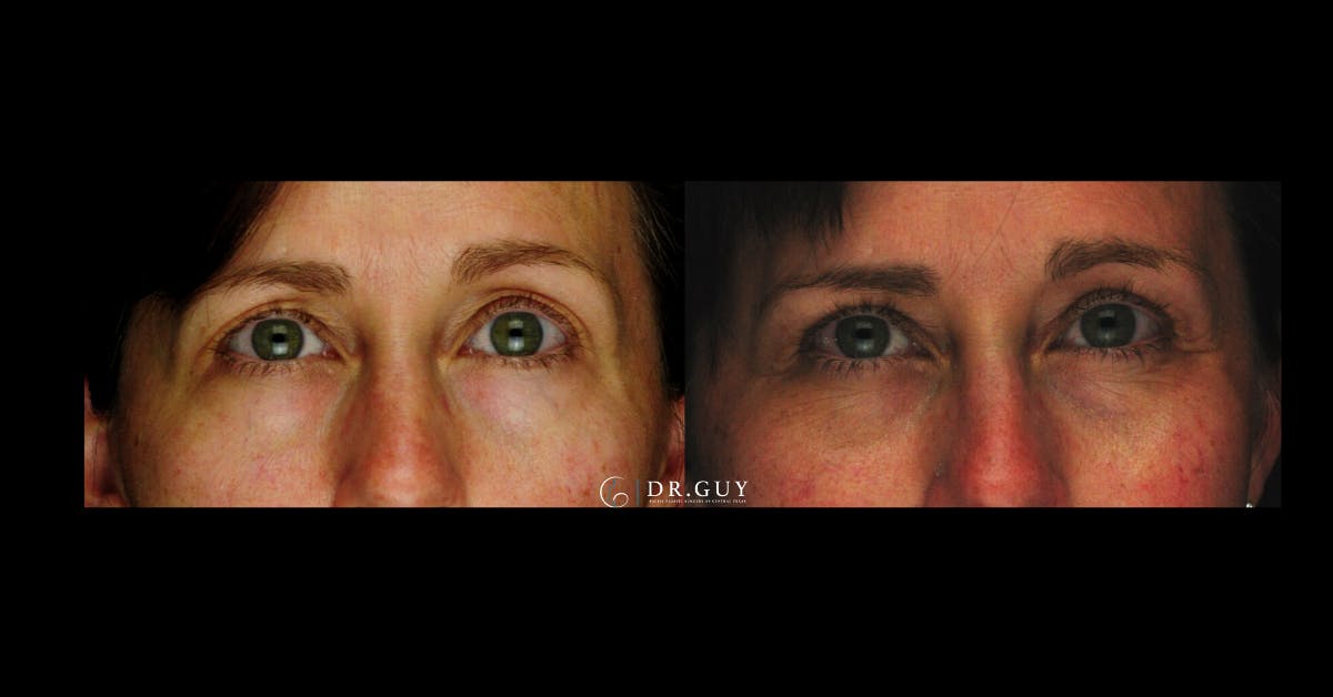 Browlift Before & After Gallery - Patient 251117 - Image 3