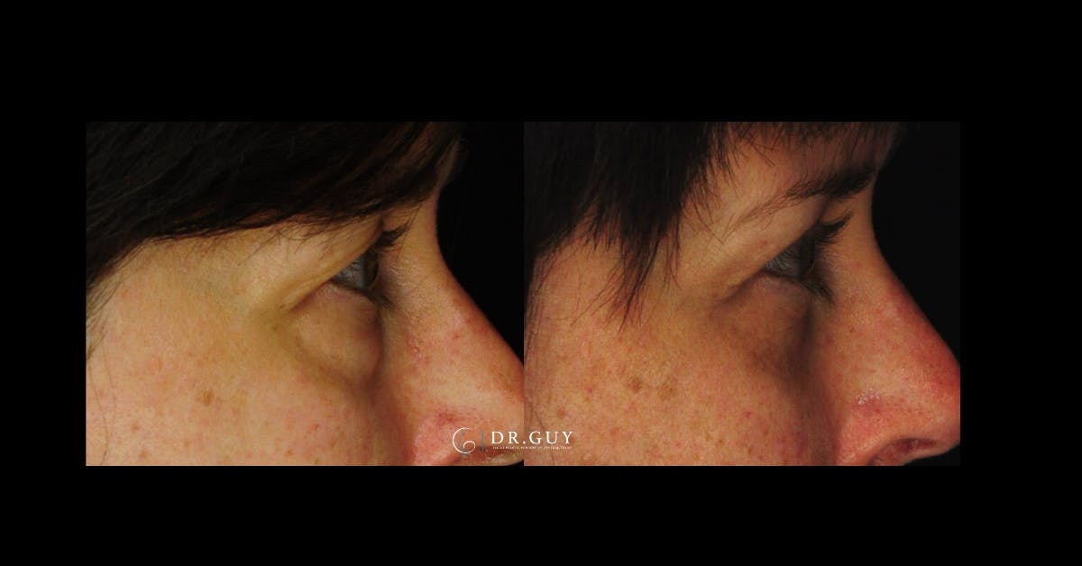 Browlift Before & After Gallery - Patient 251117 - Image 5