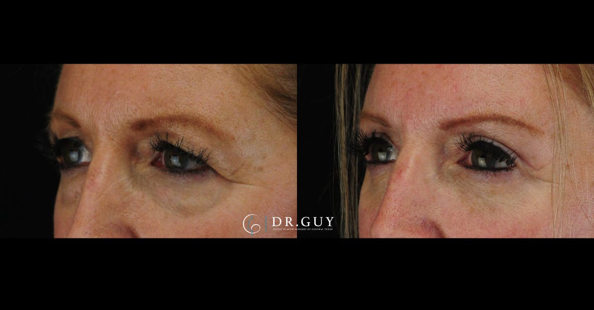 Upper Blepharoplasty Before & After Gallery - Patient 880632 - Image 1