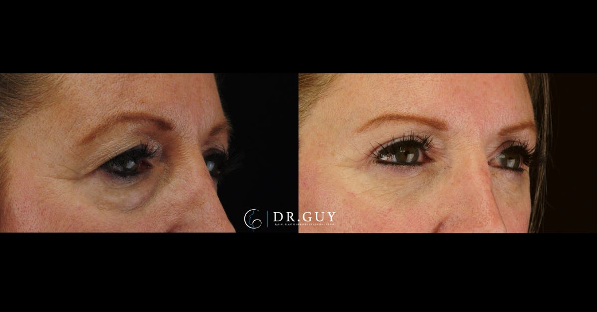 Upper Blepharoplasty Before & After Gallery - Patient 880632 - Image 2