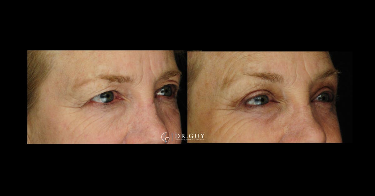 Browlift Before & After Gallery - Patient 185601 - Image 2
