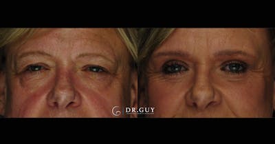 Lower Blepharoplasty Before & After Gallery - Patient 386958 - Image 1