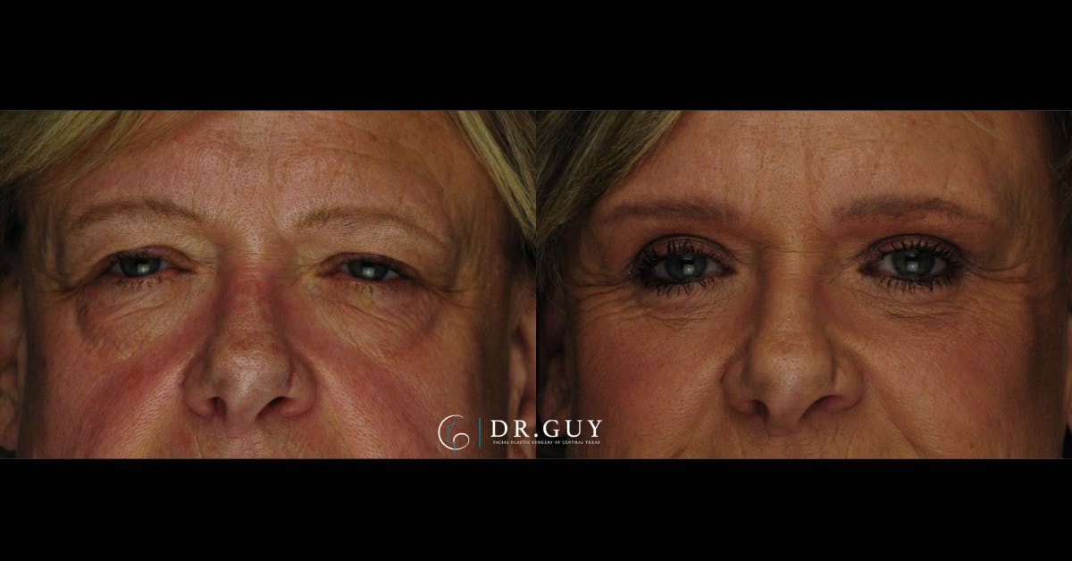 Lower Blepharoplasty Before & After Gallery - Patient 386958 - Image 1