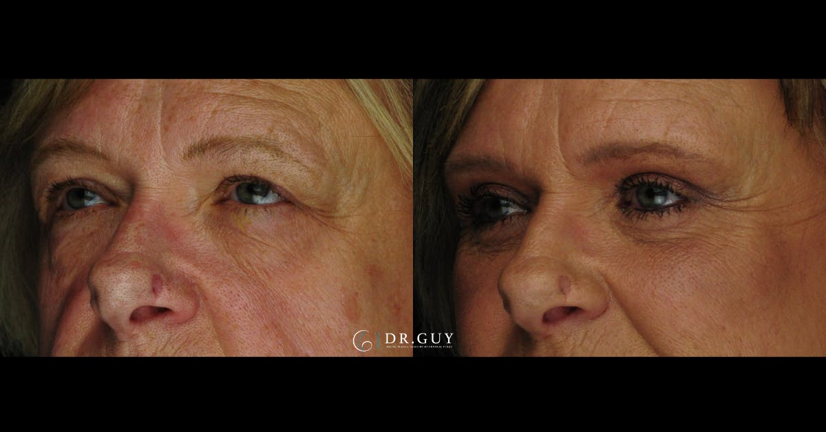 Lower Blepharoplasty Before & After Gallery - Patient 386958 - Image 2