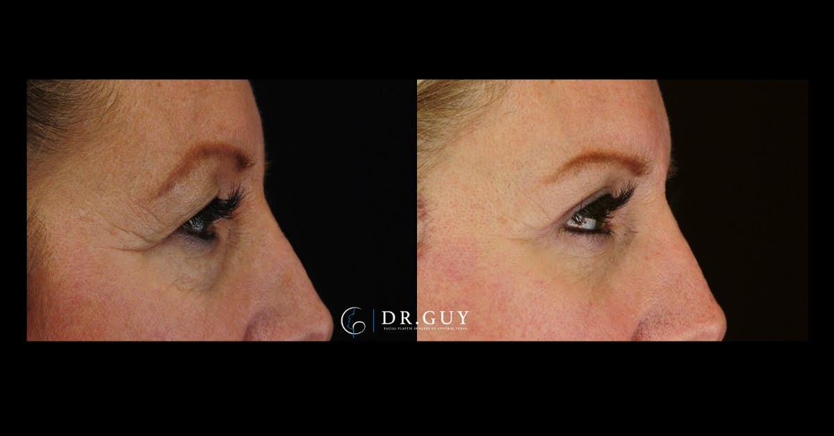 Upper Blepharoplasty Before & After Gallery - Patient 880632 - Image 5