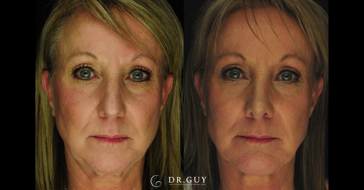 Surgical Rhinoplasty Before & After Gallery - Patient 298745 - Image 2