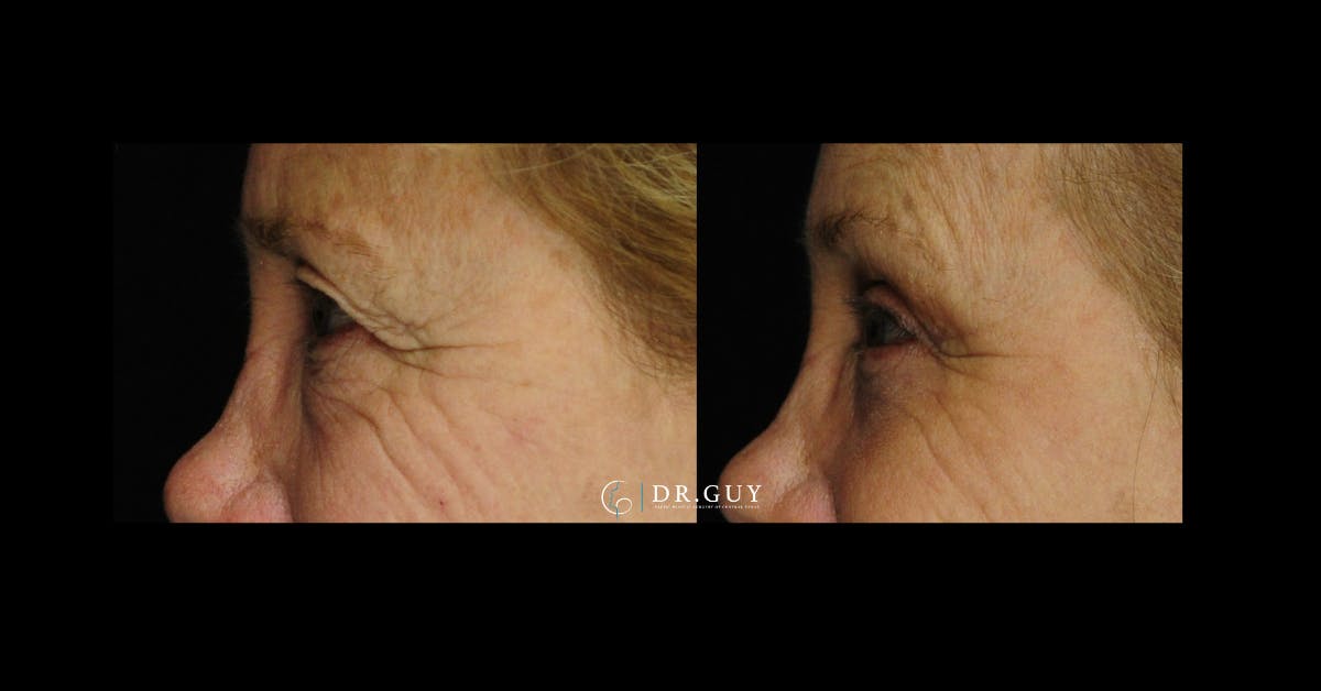 Browlift Before & After Gallery - Patient 185601 - Image 4